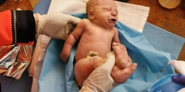 Boj o život miminka v inkubátoru