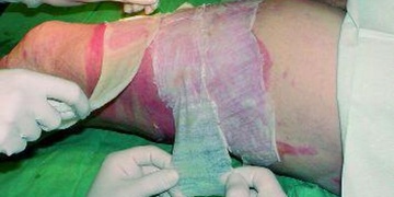 Spícímu kamarádovi z legrace zapálili rozkrok