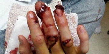 Výbuch pyrotechniky prakticky utrhl dvanáctiletému chlapci prsty