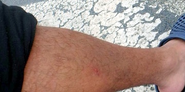 Útok nožem se mu nepovedl, tak oběť alespoň pokousal