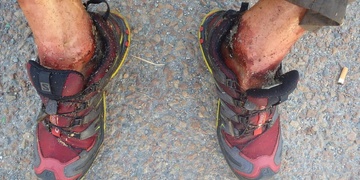 Červi v nohou, opilci řídili i se prali u lékaře a další