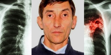 Policisté pátrají po Rumunovi nakaženém TBC, který se vyhýbá léčení