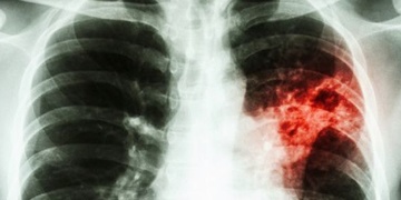 Firma sídlící na Borských polích posílá zaměstnance na rentgen plic